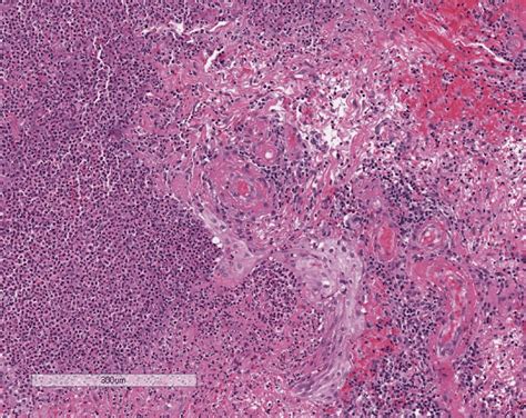 Histological Features Of Biopsy Area Of Inflammation With Neutrophilic