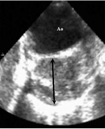 Figure 4. Intramural hematoma of the descending aorta is shown in a ...