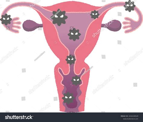 Endometritis Inflammation Lining Uterus Called Endometrium Stock Vector