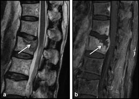 Sclerotic Lesions Of The Spine Mri Assessment Mugera