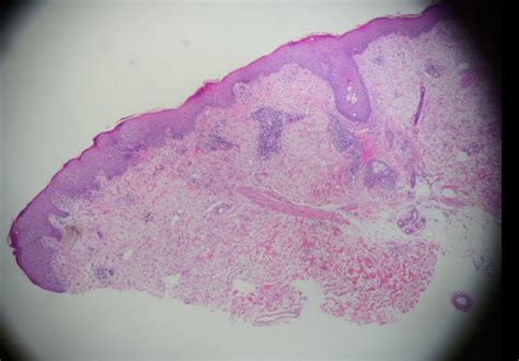 Lipoma Dermatopathology Teaching Slides Human Pathology Off