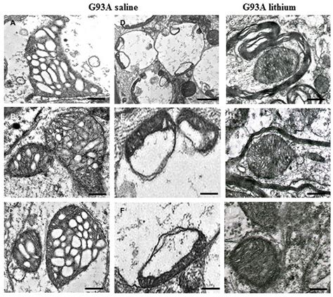 Paradigm Of Severe Mitochondrial Alterations In Als Motor Neurons The