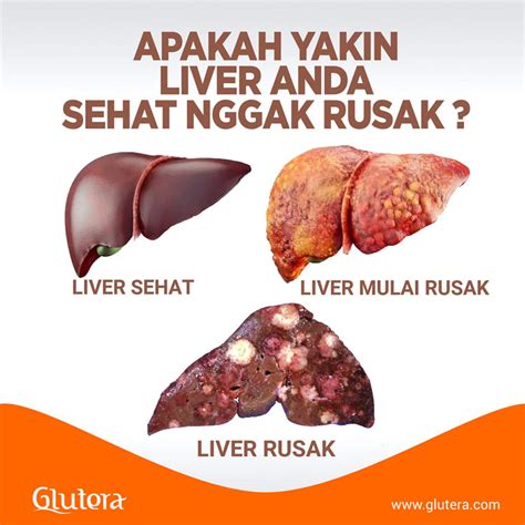 5 Cara Ampuh Atasi Penyakit Liver Rahasia Menuju Kesehatan Sempurna