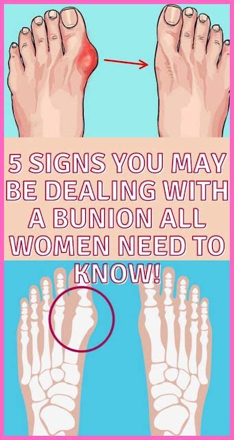 Bunion – Symptoms, Diagnosis And Treatment - Healthy Lifestyle