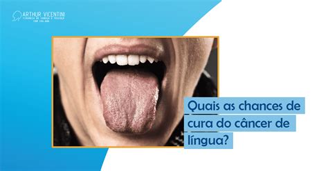 Corte Na Lingua O Que Passar - Cancer De Lingua Precoce 10 Sintomas Do Câncer Que Podem Passar