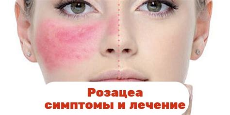 Розацеа: виды, причины, симптомы и лечение розацеа