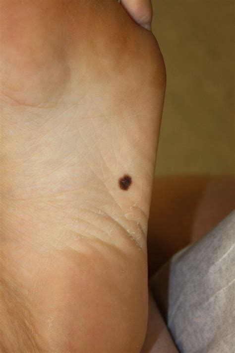 Black Marks On Foot Shop Emergencydentistry