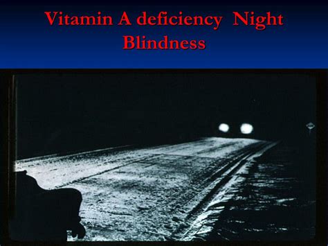 vitamin  deficiency powerpoint    id