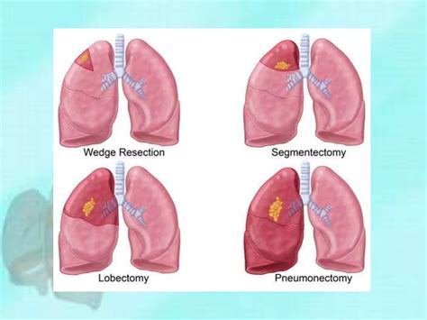 Lung cancer surgery | PPT