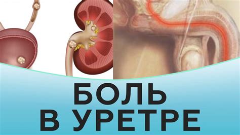 Боль в уретре у мужчин лечение - YouTube