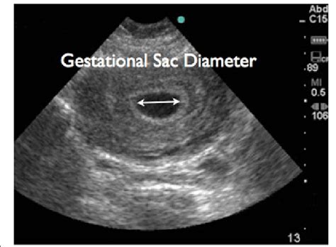 Yolk Sac Measurement Ultrasound