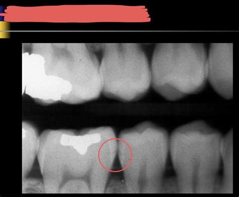 Preclinical Radiology Lecture 4 Caries Flashcards Quizlet