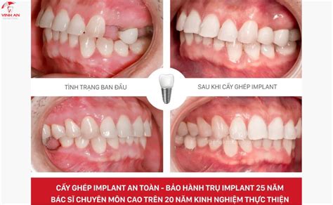 Implant Kit Bộ Dụng Cụ Phẫu Thuật Trong Cấy Ghép Implant
