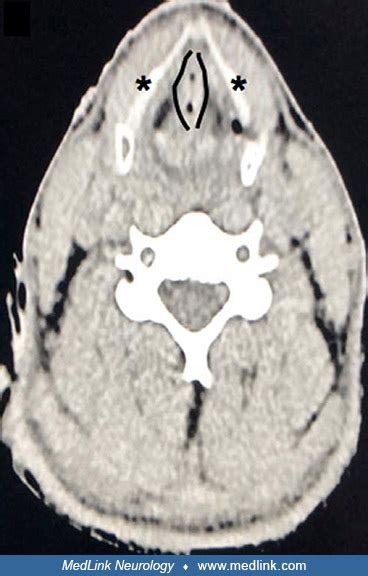 Lightning Injuries Neurologic Complications Medlink Neurology