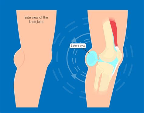 Baker's Cyst Behind Knee Hurts at Patrick Drago blog