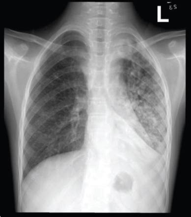 Pulmonary Tuberculosis Chest X Ray