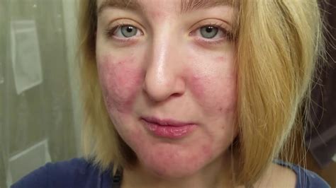 Nodular Acne Treatment Accutane 3 Month Progress Youtube