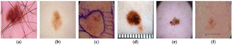 Cancers Free Full Text Squeeze Mnet Precise Skin Cancer Detection