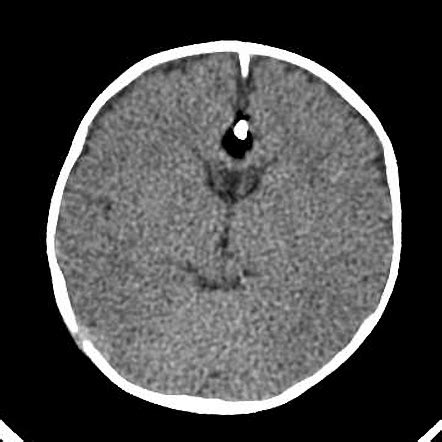 Tubulonodular Pericallosal Lipoma And Callosal Dysgenesis Radiology