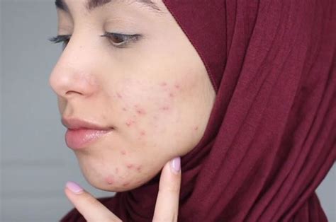 mengatasi masalah kulit berjerawat  pemakai hijab  pakar