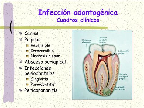 Ppt Uso De Antibi Ticos En La Infecci N Odontog Nica Powerpoint