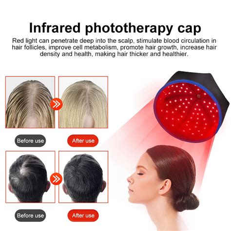 does red light therapy help hair growth 1