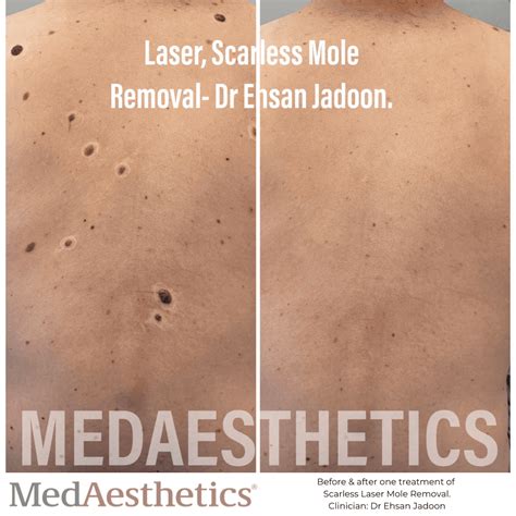 Skin Tag Removal Perth Laser Mole Removal Perth Medaesthetics