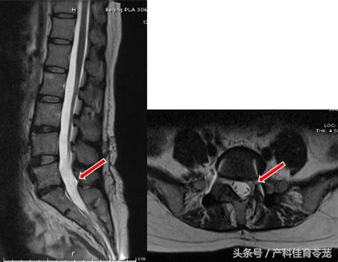 想腰椎術後不復發，試試腰椎DYNESYS動態穩定系統 - 每日頭條