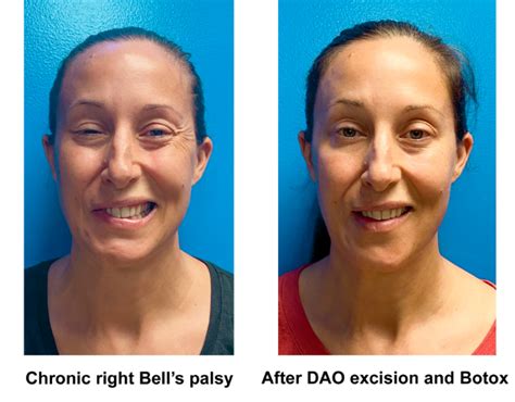 Bells Palsy Unc Facial Nerve Center