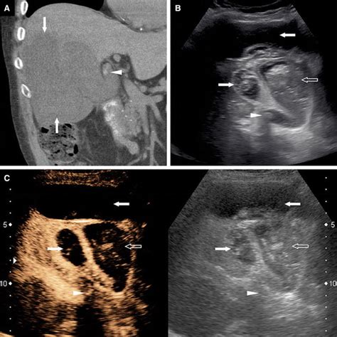 Contrast Enhanced Ultrasound In Gallbladder Disease A Pictorial Review