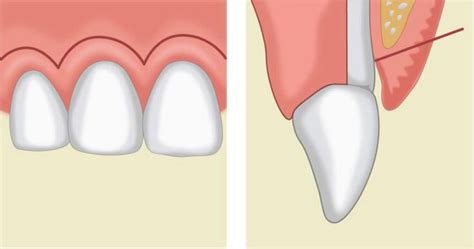 Flap Techniques In Dentoalveolar Surgery Intechopen