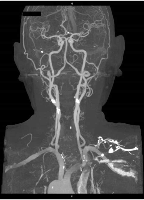 Head Ct Scan Ct Scan Circle Of Willis Scan Images