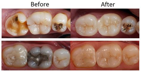 Dental Crowns and Bridges