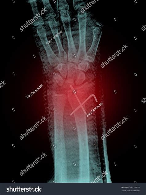 how to know if your wrist is broken 6