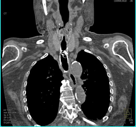 Stent In Trachea In 3d With Tracheal Stenosis Chest Case Studies