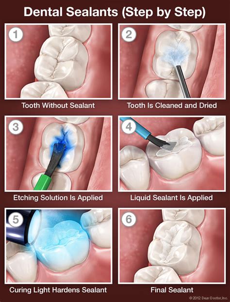 Alpharetta Dentist Discusses Benefits Of Dental Sealants