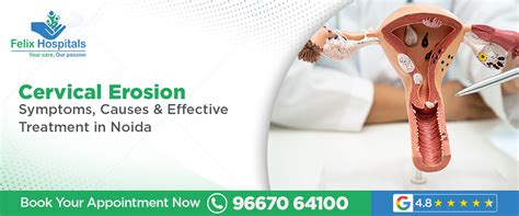 cervical erosion symptoms  effective treatment  noida