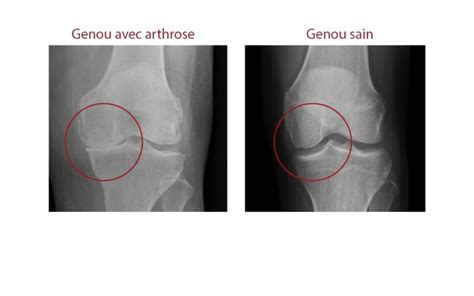 L Arthrose Du Genou Sympt Mes Et Gu Rison P Le Reyactive Morestel