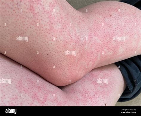 Pelle Chiazzata Calore Eruzione Cutanea Orticaria Reazione Allergica Al