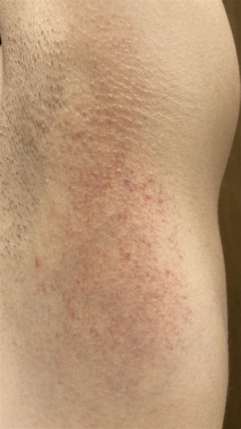 Armpit Rash Rdermatologyquestions