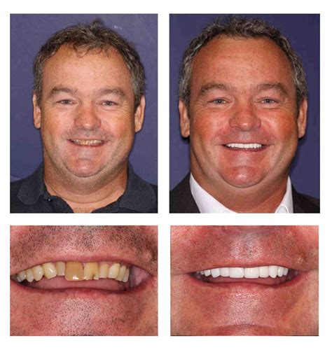 Full Mouth Reconstruction Pga Dentistry