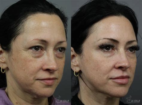 Sculptra® Before And After Gallery