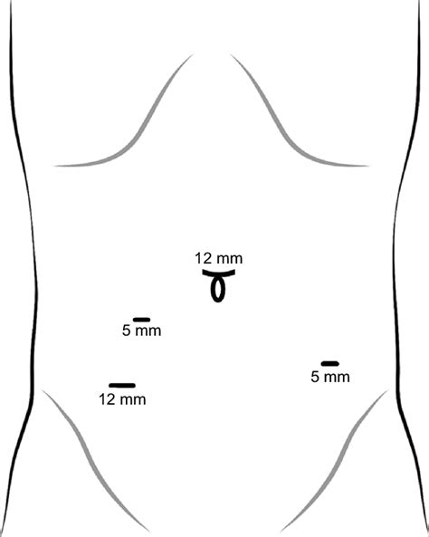 Trocar Placement And The Size Of The Trocars Download Scientific Diagram