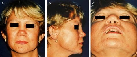 Reconstructive Surgery Of The Leprosy Nose A New Approach Journal Of Plastic Reconstructive