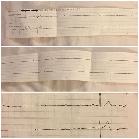 ventricular standstill medizzy