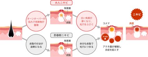 【医療従事者監修】思春期ニキビの原因とは？他のニキビとの違いについても解説 ニキビ、ニキビ跡、赤ら顔の改善なら渋谷美容外科クリニック