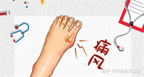 痛风这几大主要并发症，要注意！ 知乎