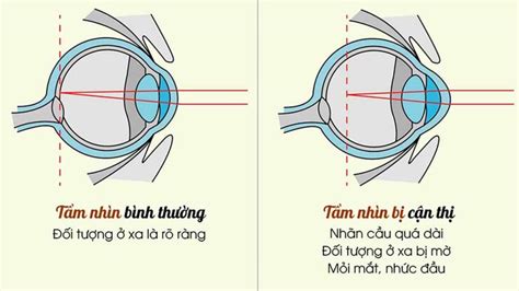 Cận Thị Một Bên Mắt Nguyên Nhân Dấu Hiệu Và điều Trị Nhà Thuốc Fpt