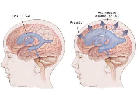 Hidrocefalia O que é e como se pode tratar NeuroVida Clínica de