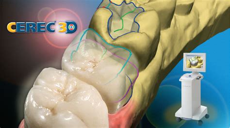 Cerec Crowns Better Than Traditional Crowns Dental Solutions Of Avon